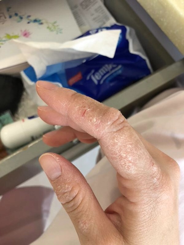 神经性皮炎使用前1使用2周后脚跟粗糙 使用前2使用1周后脚跟干裂 使用