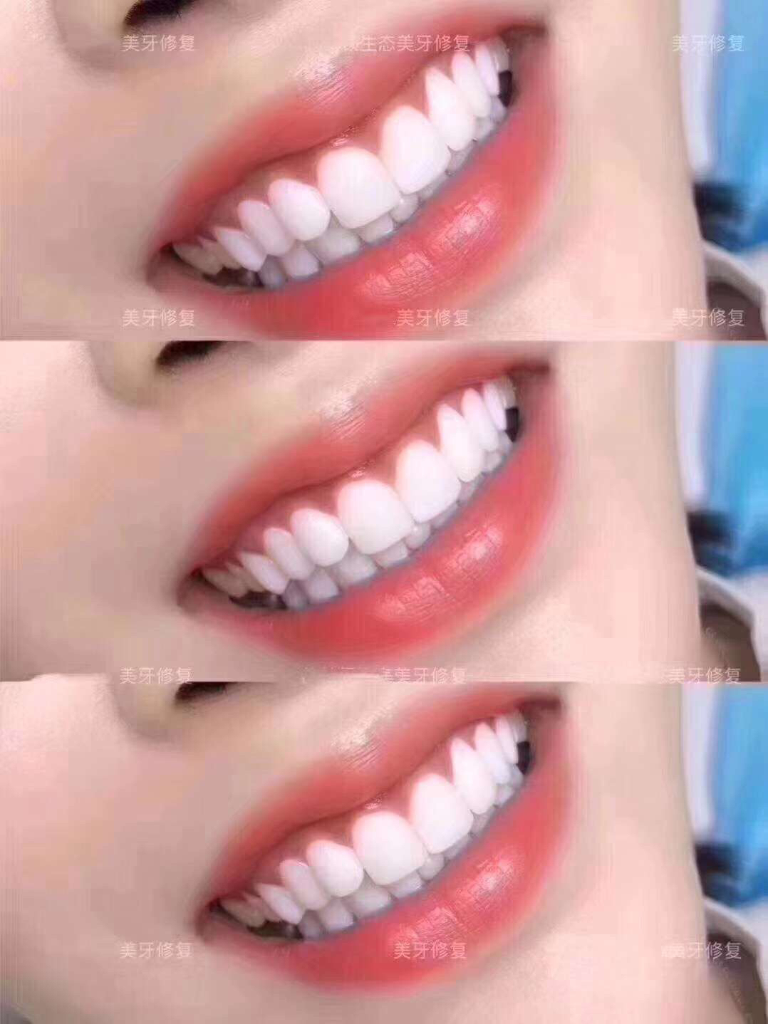 纳米齿雕美牙