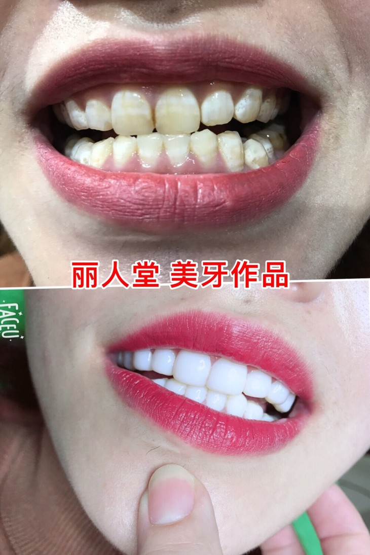 纳米齿雕美牙