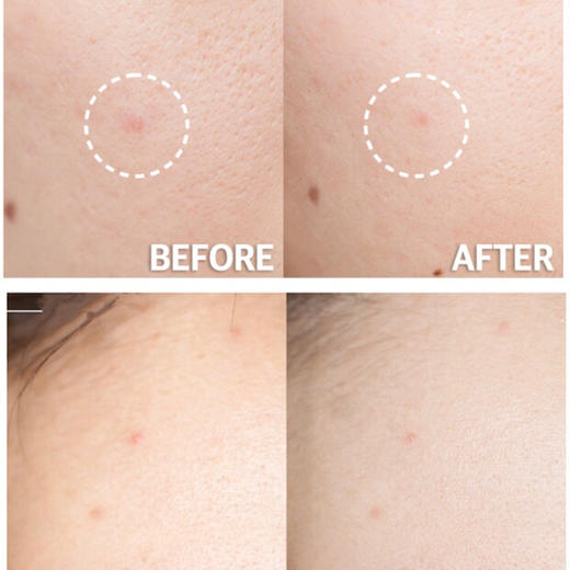 STRIDEX/施颜适水杨酸棉片 深层清洁面膜 商品图6