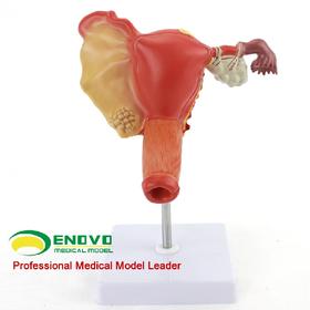 现货速发【医教模型】ENOVO颐诺人体子宫卵巢阴道疾病模型 女性内外生殖科妇产科医学用