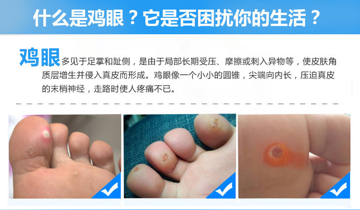 恒健水杨酸苯酚贴膏6片盒1盒用于鸡眼