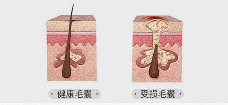 掉发,其实就是头皮不健康了,毛囊萎缩,留不住头发.