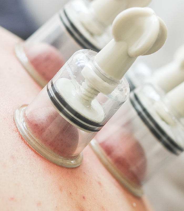 家庭扭式拔罐器4件套 | 树脂材质简单耐用.旋转负压可调节.