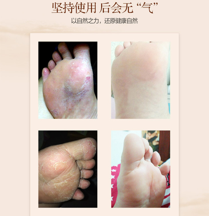 韦香儿马油脚气膏_07