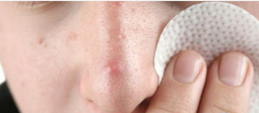 夏天痘痘更容易加重和复发，为什么？