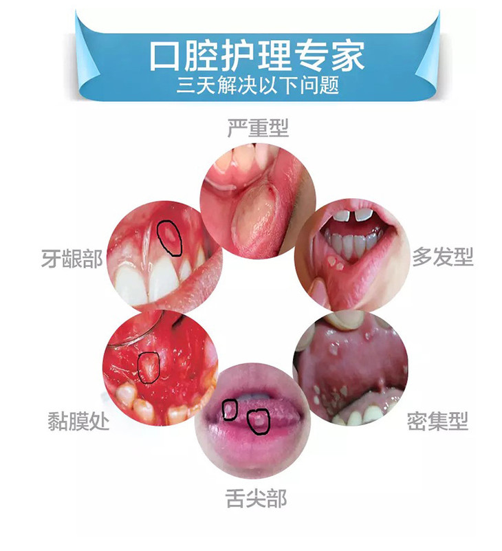 广雅牌草珊瑚口腔溃疡抑菌液30ml支