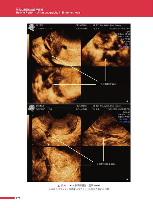 《子宫内膜异位症超声诊断》 商品图1
