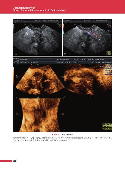 《子宫内膜异位症超声诊断》 商品图3