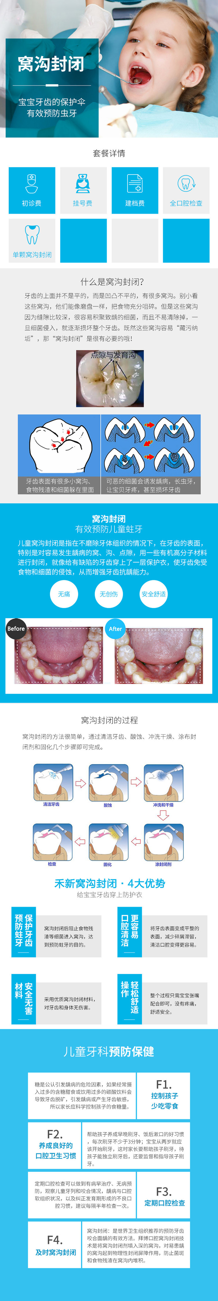 窩溝封閉套餐(單顆)