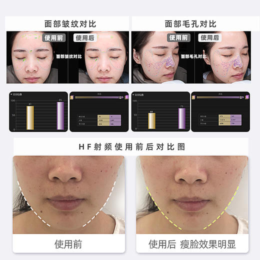 【赠凝胶】【家用美容仪】日本JUJY纪芝射频脸部美容仪一代【品牌直发】 商品图7