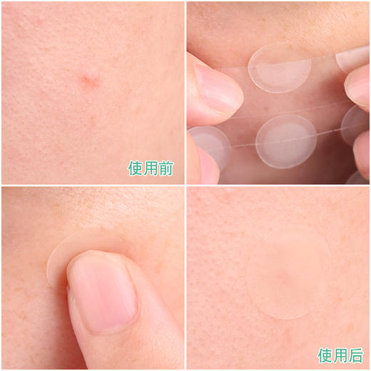 韩国vt隐形痘痘贴老虎cica修护痘痘粉刺闭口青春痘48贴