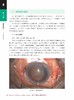 手法小切口白内障手术技巧  眼科外科书籍 眼科手术 大量高清手术图片及精美手绘图片 商品缩略图5