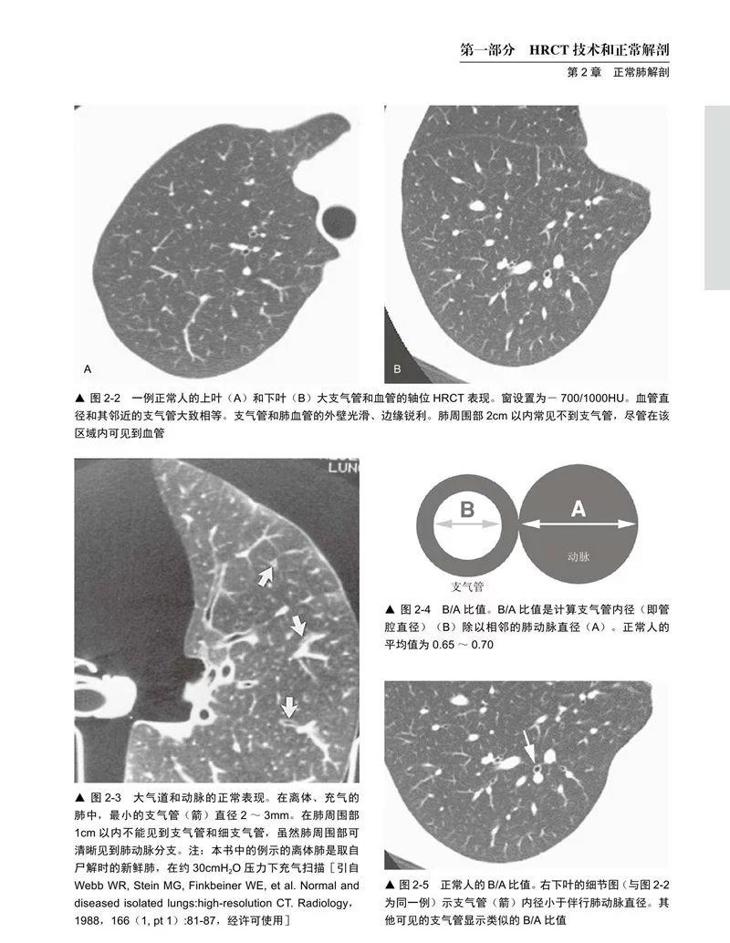 高分辨率肺部CT 全新第5版国际经典译著