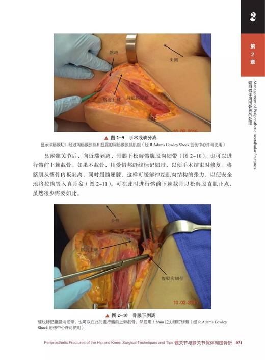 髋关节与膝关节假体周围骨折 引进自德国 Springer 出版社的一部关节外科学著作 外科学 骨科学 医学专著 商品图5