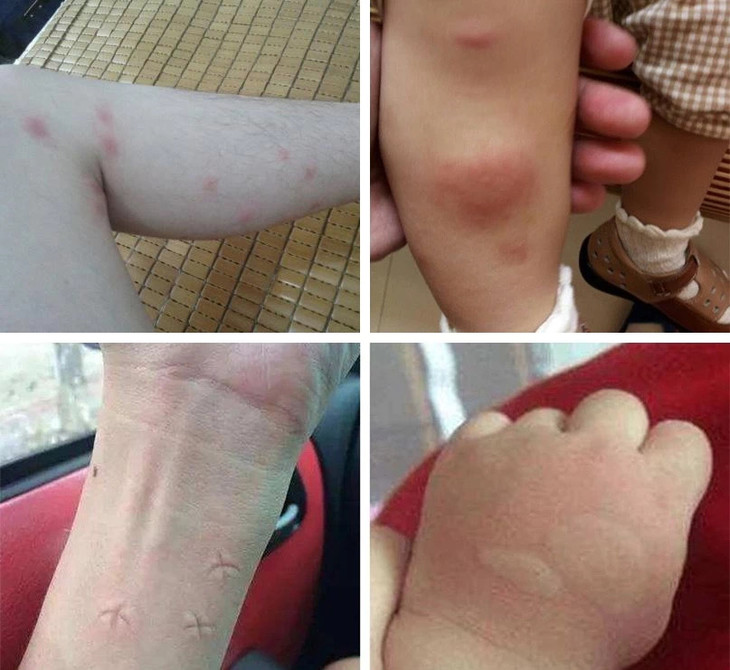 蚊虫携带流行性乙型脑炎,登革热,疟疾等疾病,如果恰好有伤口,入侵后