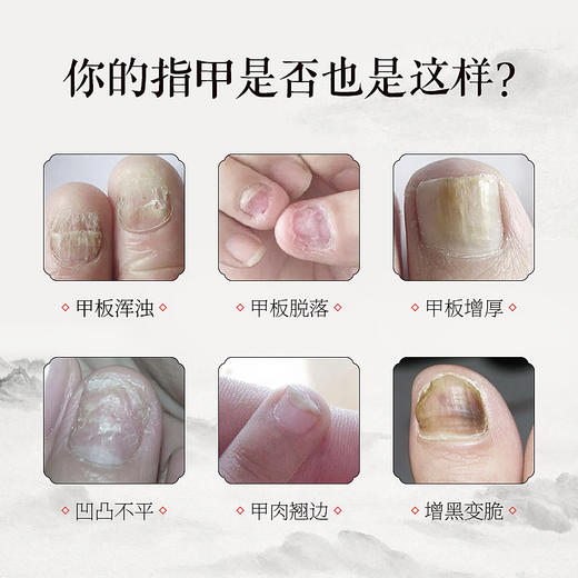 【械字号冷敷敷料】肌肤之食灰指甲膏——安全无痛，持久渗透 商品图1