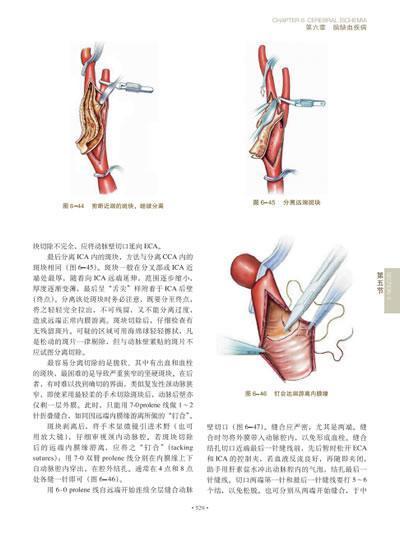 脑脊髓血管外科学 中国脑血管外科原创精品、我国神经外科界泰斗和神经外科开拓者的倾力奉献、神经外科的百科全书 商品图11
