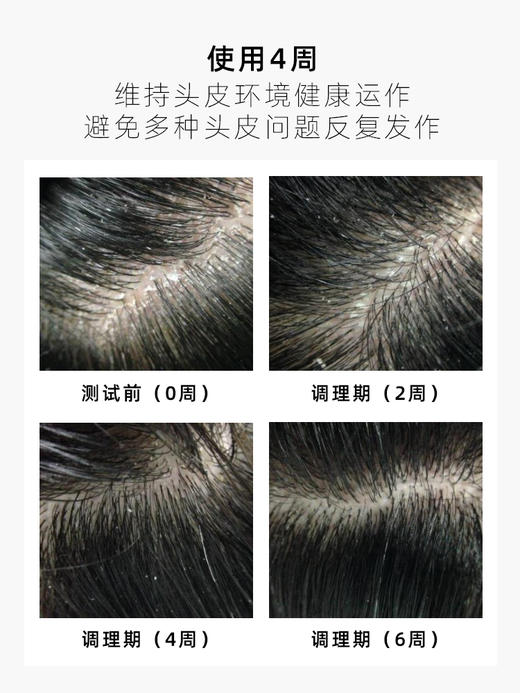 KIMTRUE 头皮净透凝露 10ml*5支 商品图3