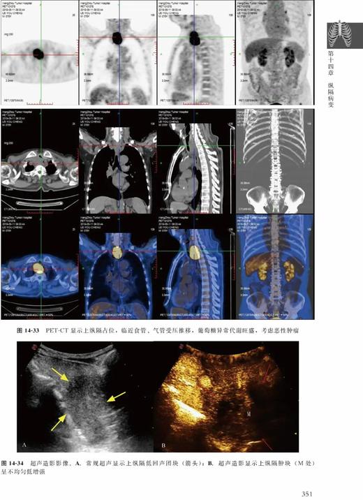 肺部疾病超声诊断临床解析 张骅 北医社 商品图6