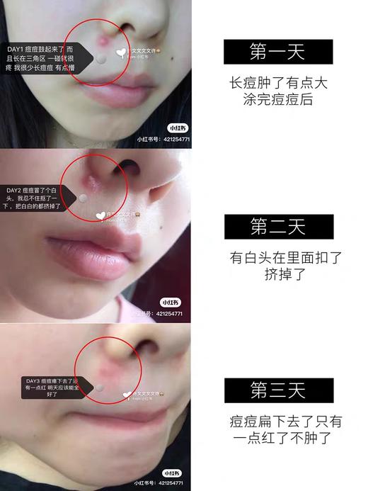 悦木之源净痘祛痘凝胶10ml疏通毛孔淡化痘印舒缓修复肌肤 商品图3