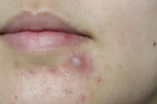 芙芙祛痘贴夜用36枚（老款停产） 商品图4