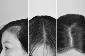 【头屑问题】头痒、头屑、头油者进入