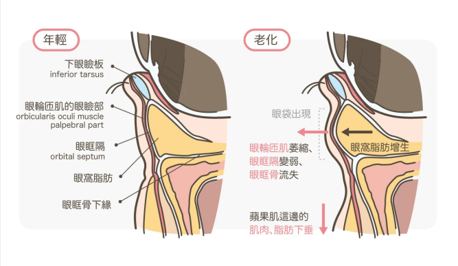 安心,无痛,效果快 眼袋形成除了由衰老引起的 眶周结构,眼轮匝肌和
