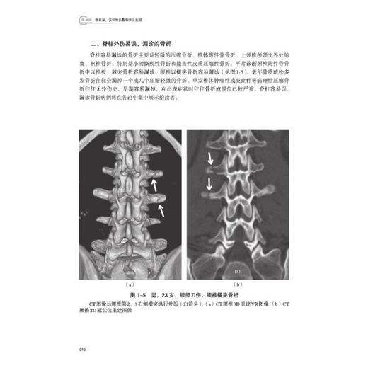 容易漏、误诊骨折影像学及图谱 商品图1