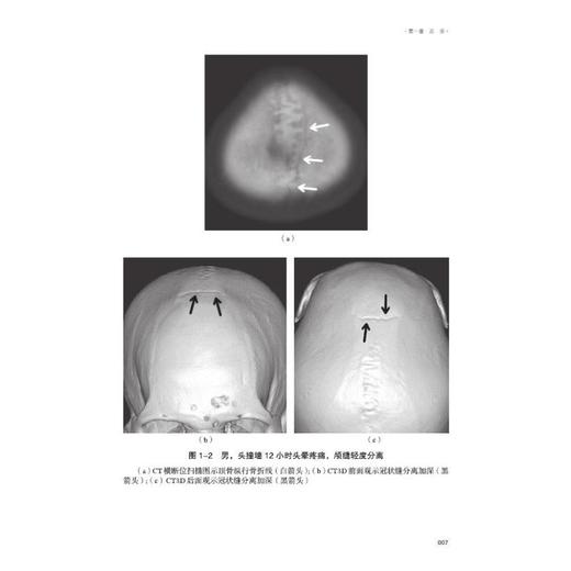 容易漏、误诊骨折影像学及图谱 商品图2