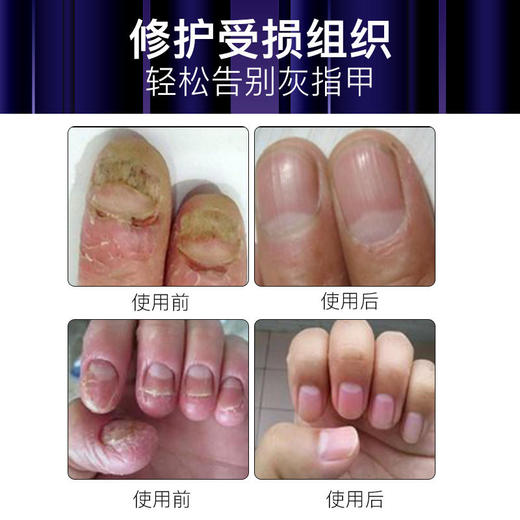 【德国SOS灰指甲笔】德国微生物科技，修护受损组织，恢复指甲光泽 商品图4