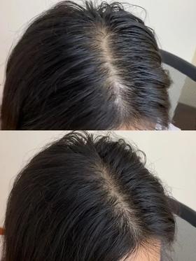  案例 | 小姐姐亲测Minoximax（米诺增效），40天长出小发茬！ 