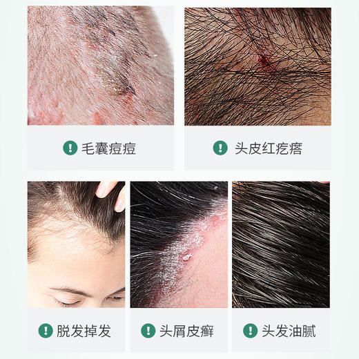 【买3发5】三椒除螨洗发皂植物精粹成分深层清洁滋养头皮100g/盒 商品图1