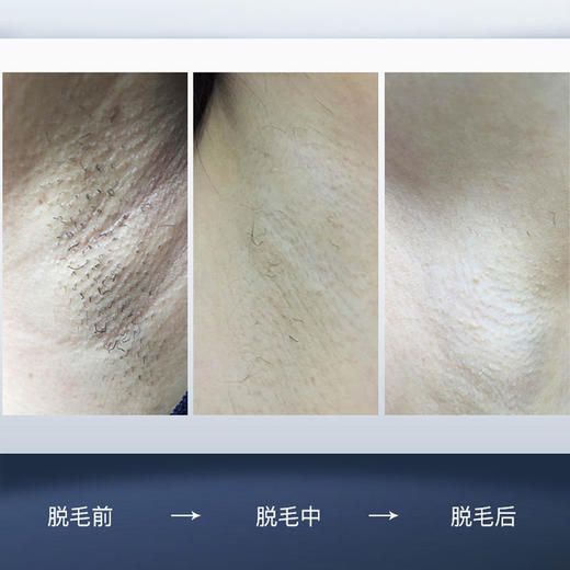 英国慕金Smoothskinmuse冰点激光脱毛仪器家用光子私处脱毛仪 [福利品] 商品图3
