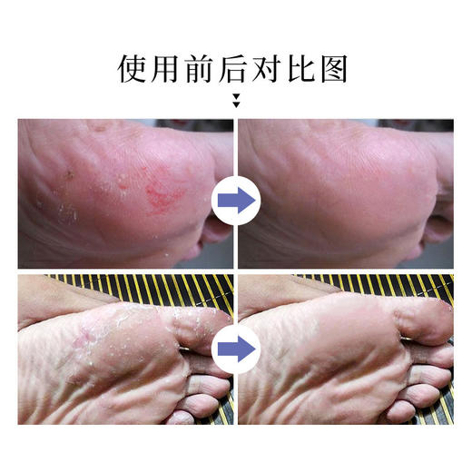 【李佳琦推荐，德国SOS足部喷雾】除脚臭鞋袜除味剂250ml夏天足部抑菌除味喷雾鞋袜鞋柜除臭剂杀菌止痒去脚气去脚汗脚臭消毒抑菌止痒喷雾 商品图4