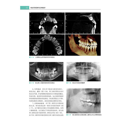 阻生牙的诊断与正畸zhi疗 商品图9