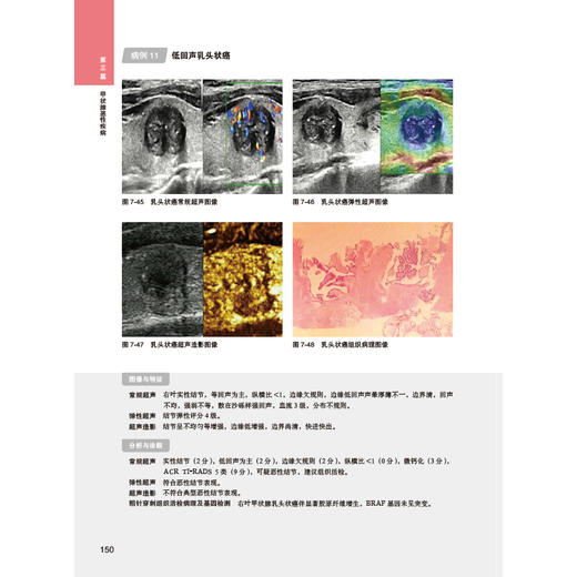 甲状腺及甲状旁腺结节超声诊断图谱 商品图4