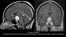 2020/Top6.内镜下血管母细胞瘤切除术