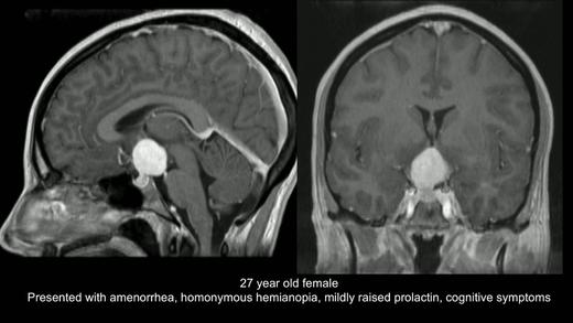 2020/Top6.内镜下血管母细胞瘤切除术 商品图0