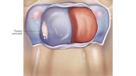 2020/Top10.内镜下垂体腺瘤模拟手术录像
