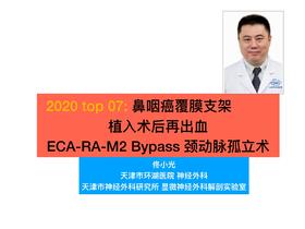 2020/Top07- 鼻咽癌再出血ECA- RA- M2 Bypass