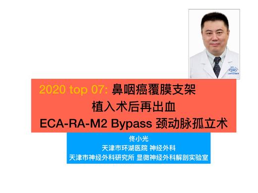 2020/Top07- 鼻咽癌再出血ECA- RA- M2 Bypass 商品图0