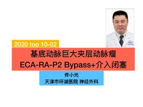 2020/Top02-基底动脉巨大夹层动脉瘤bypass+介入