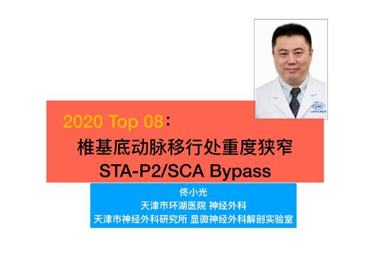 2020/Top08-基底动脉重度狭窄STA-P2/SCA Bypass 商品图0