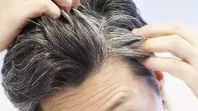 人的头部这3个位置长白发最危险！ 