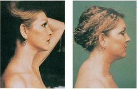 脖子粗，肩膀宽，胸背厚，不是胖！是淋巴堵了！你该做肩颈疏通了 