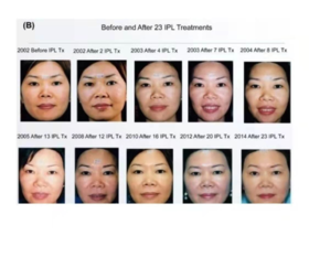 为什么光子嫩肤是小白入门首选？