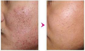 祛痘去痘印必看：用微针解决你的烦恼