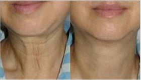 颈纹很显老？别怕，嘿体帮你解决