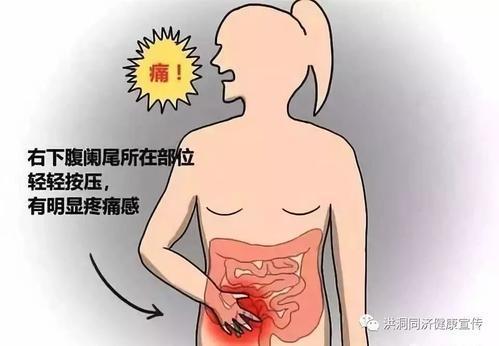 班长课堂020 | 急性阑尾炎应急处理医案 商品图0